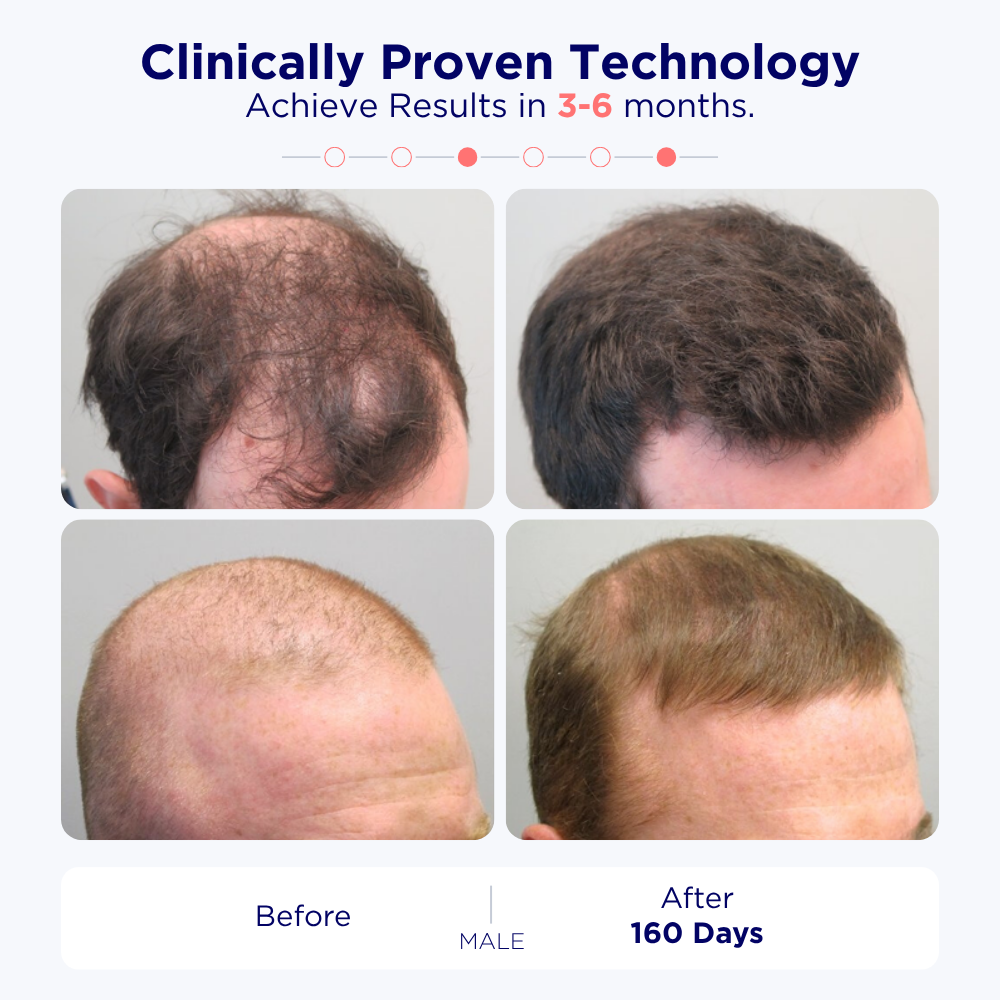 Find Your Perfect Match: Laser Hair Growth Cap for Every Stage of Hair Loss