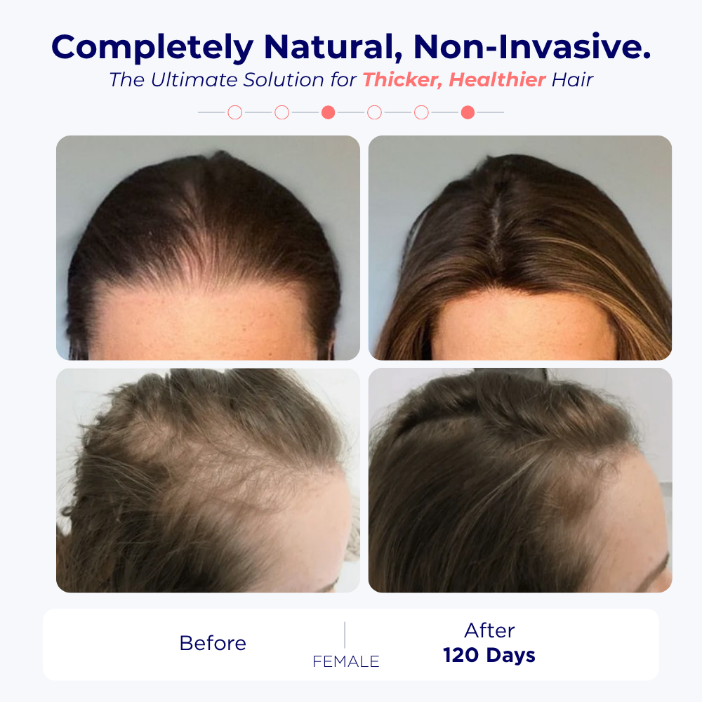 Find Your Perfect Match: Laser Hair Growth Cap for Every Stage of Hair Loss